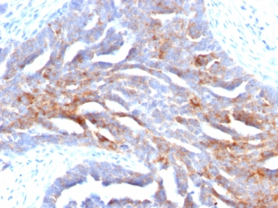 FFPE human ovarian carcinoma sections stained with 100 ul anti-TAG-72 / CA72.4 (clone B72.3) at 1:300. HIER epitope retrieval prior to staining was performed in 10mM Citrate, pH 6.0.